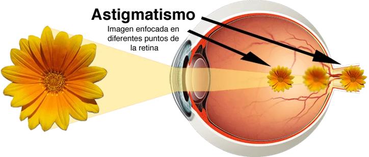 Trastornos-Astigmatismo