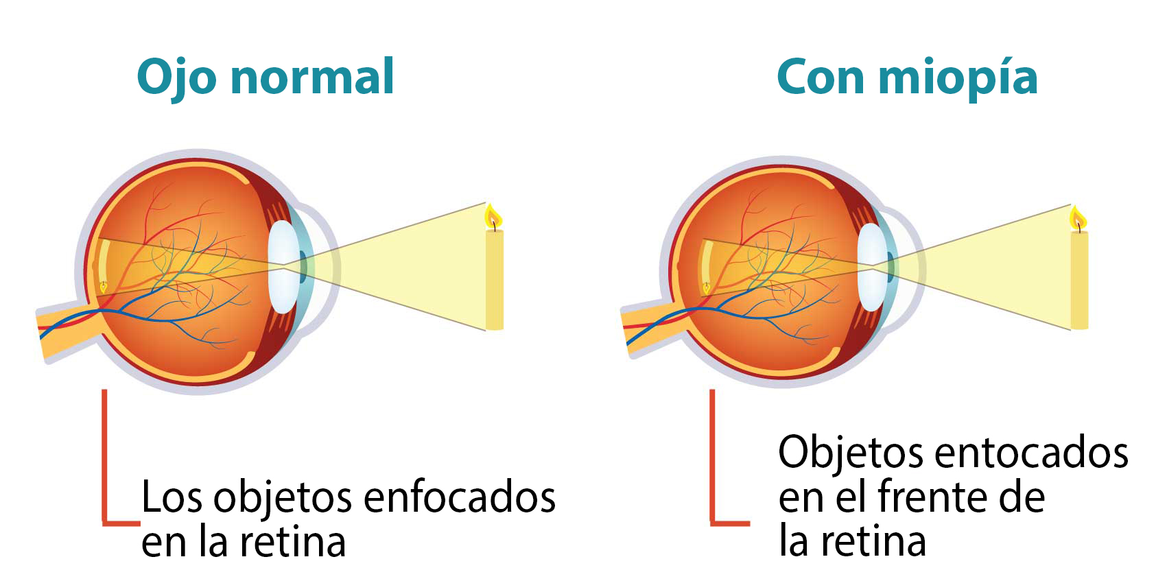 Keratoconus. Dystrophic disease of the cornea.